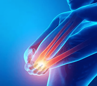 Epicondylalgia