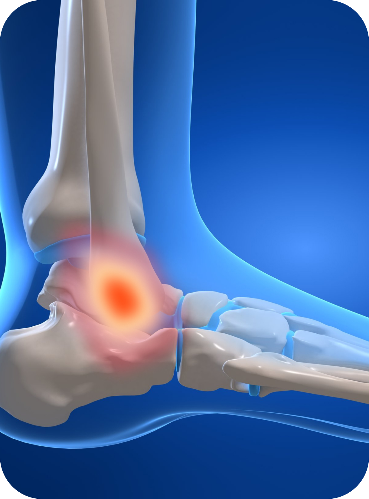 Ankle Sprains